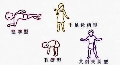 脑瘫最新分型与小巷深处的康复奇迹探索