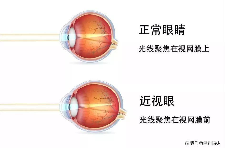 最新隐形眼镜观点论述，探索隐形眼镜的革新与发展